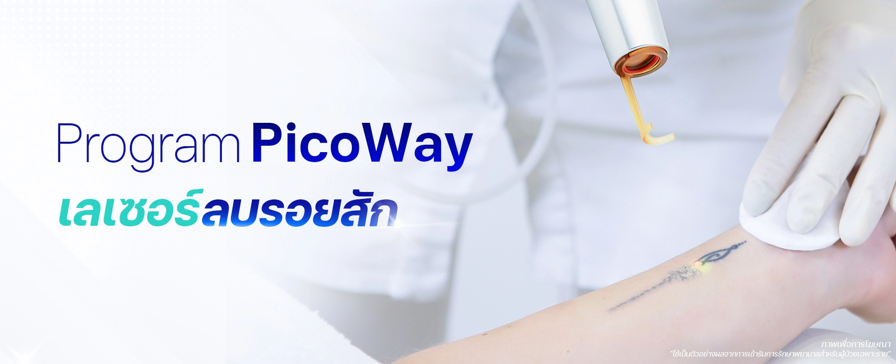 ลบรอยสัก tattoo removal