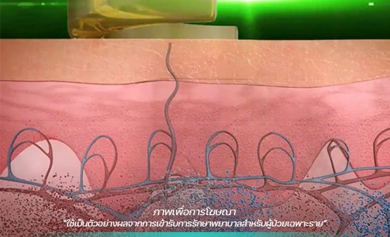 เลเซอร์รอยสัก Picoway
