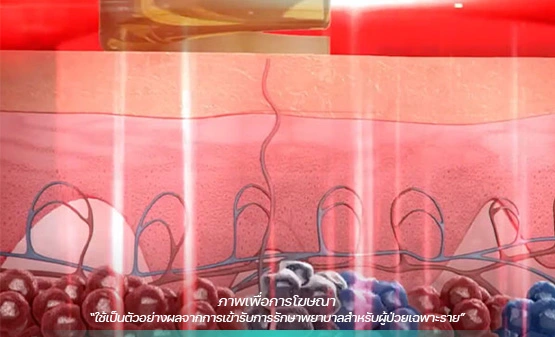 เลเซอร์รอยสัก Picoway