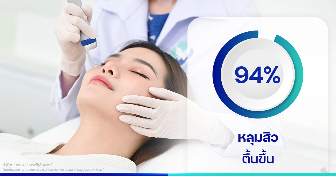 รักษาหลุมสิว